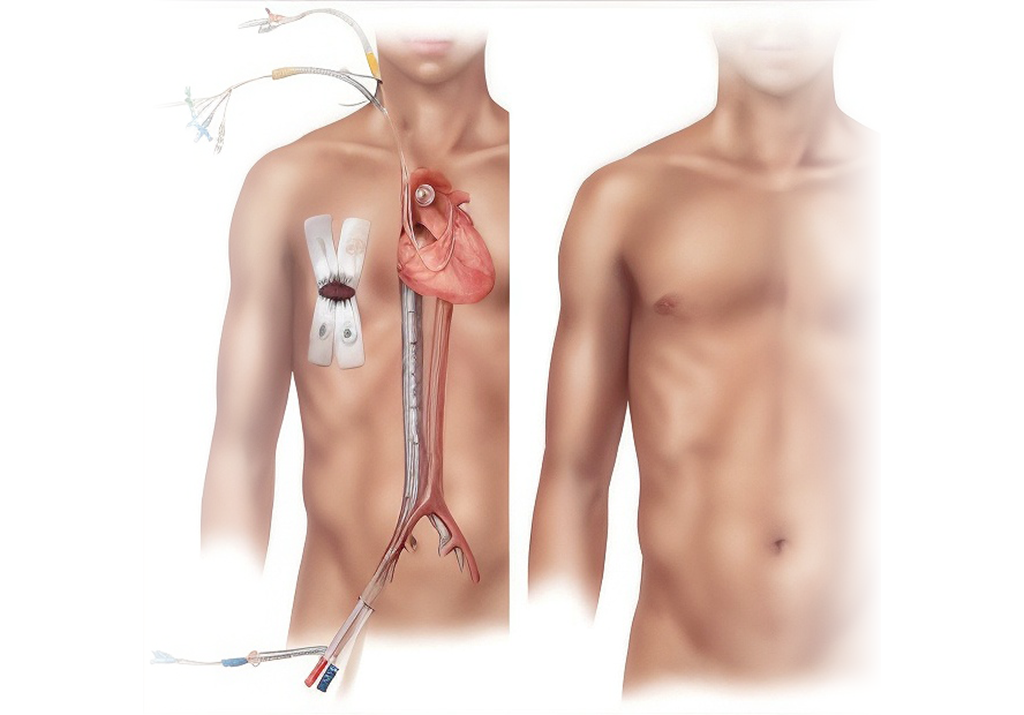 استبدال الصمامات