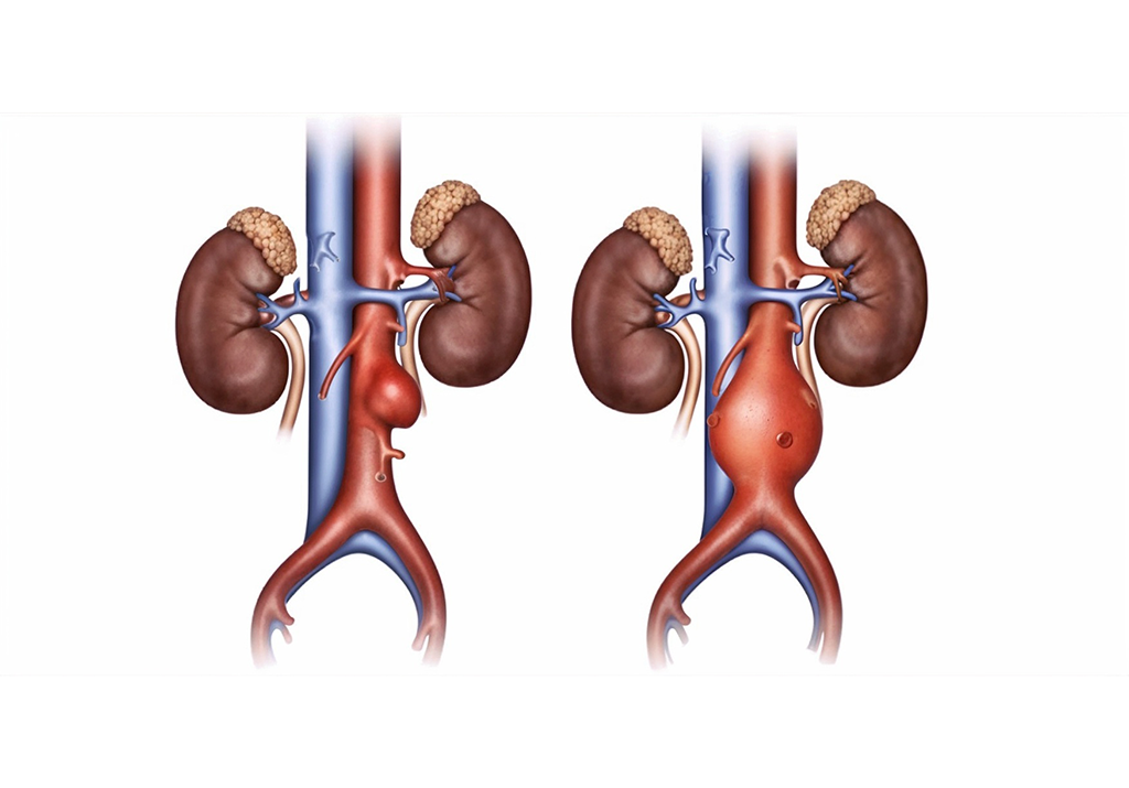 الشريان الأورطي