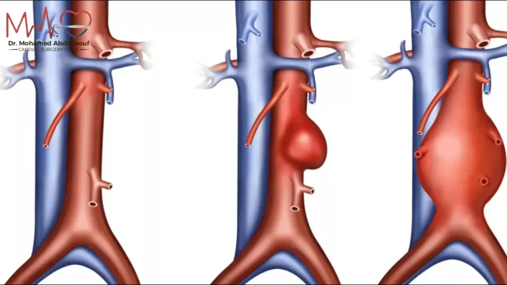 أبرز اعراض انفجار الشريان الاورطى