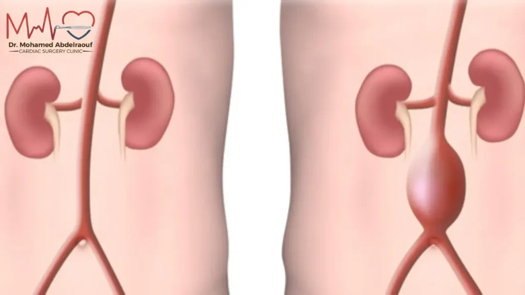 ما الذي يجب تجنبه عند تضخم الشريان الاورطى؟