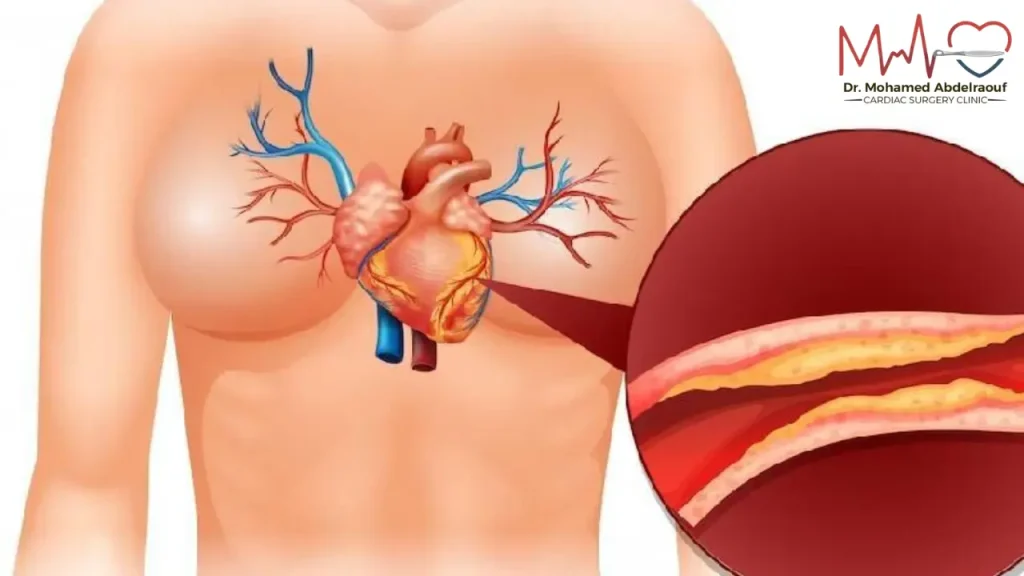 مرض الشريان التاجي 1